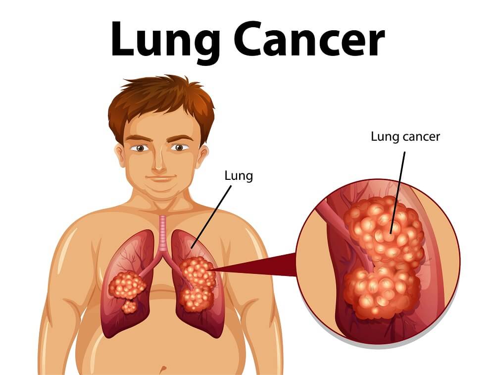 Lung Cancer Doctor in Delhi