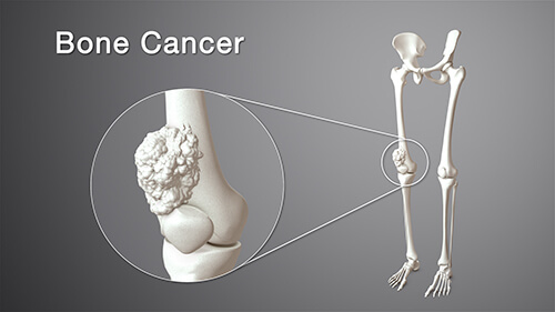 best bone cancer specialist delhi