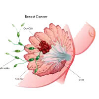 Best Breast Cancer Oncologist Delhi