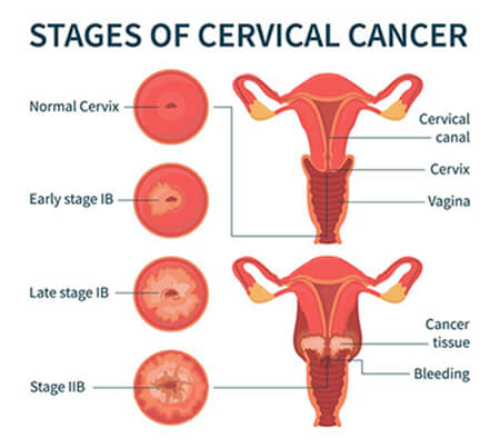 best cervical cancer specialist delhi