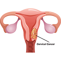 best cervical oncologist delhi