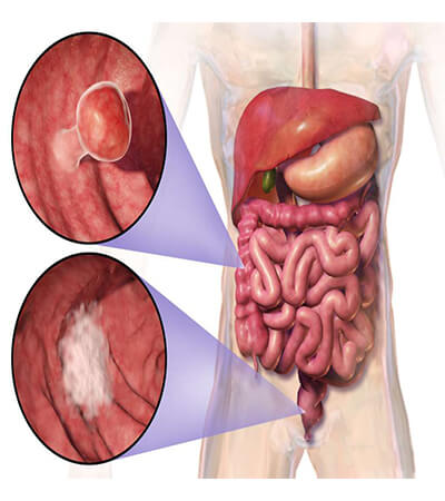 best colorectal cancer specialist delhi