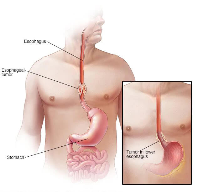 best esophageal cancer specialist delhi