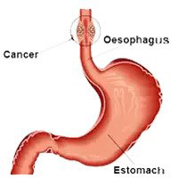 best esophageal cancer specialist delhi