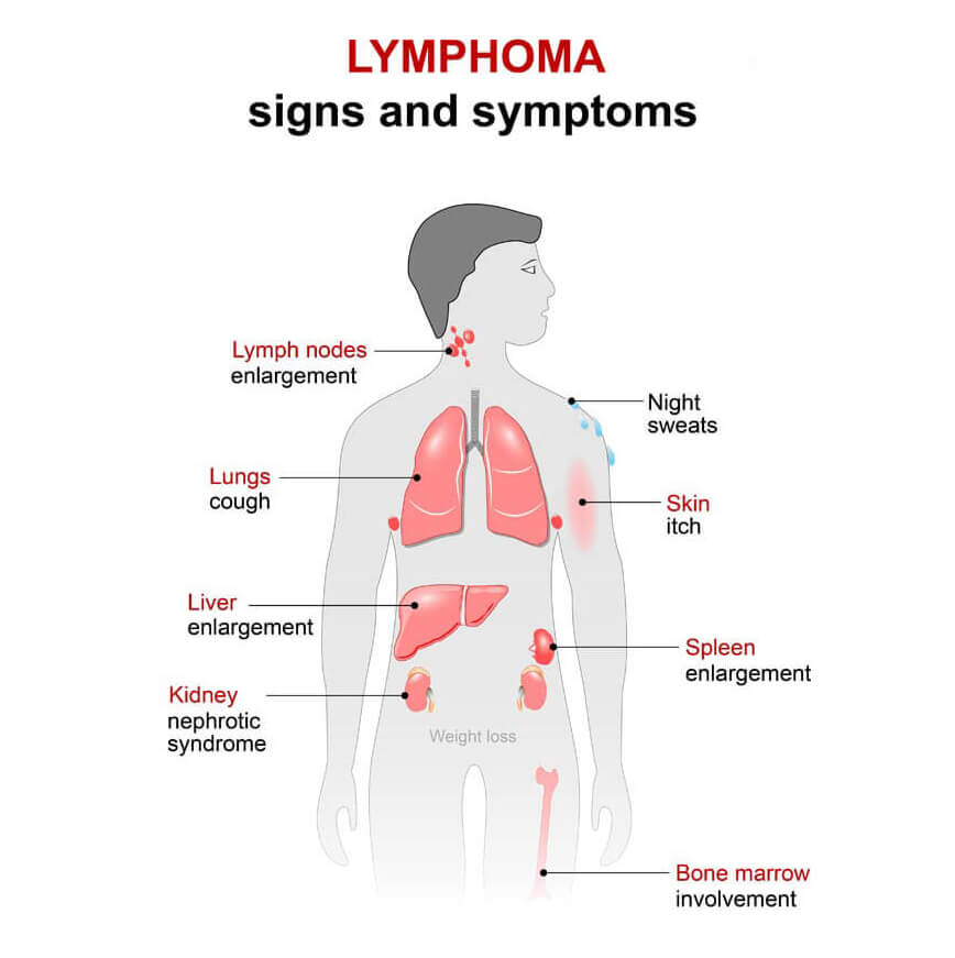 best lymphoma specialist delhi