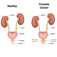 Best Prostate Cancer Specialist Delhi