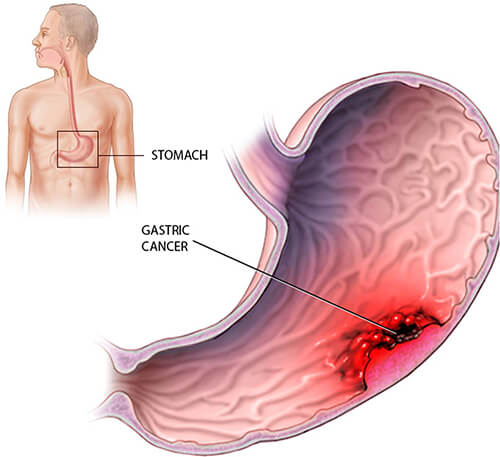 best stomach cancer specialist delhi