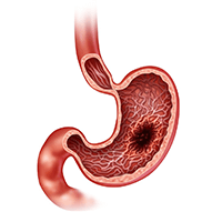 Best Stomach Cancer Specialist Delhi