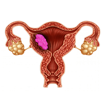 Best Uterine Cancer Doctor Delhi