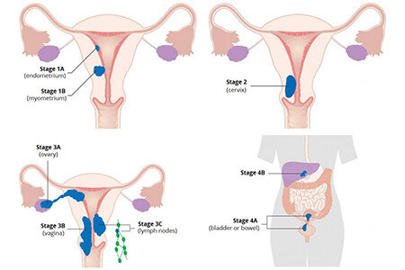 best uterine cancer specialist delhi