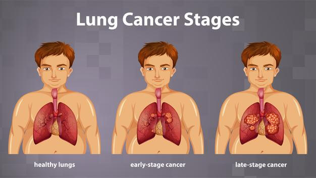 Lung Cancer Sages