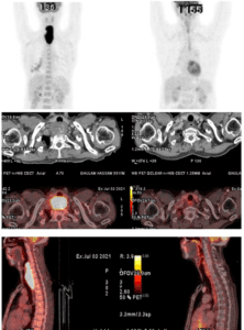 Report of esophagus cancer