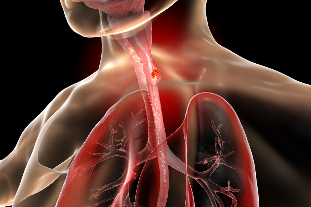 Top Esophageal Cancer Specialist Delhi