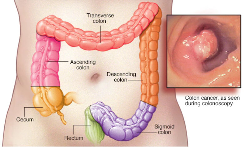 Best Colon Cancer Doctor in Delhi