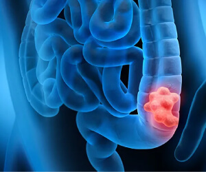 Best Colon Cancer Doctor South Delhi