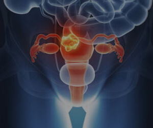 Best Gynecologic Cancer Specialist Delhi
