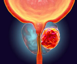 prostate cancer oncologist