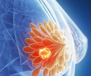 top breast cancer doctor delhi
