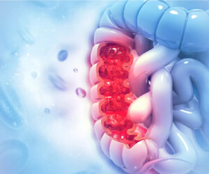 Top Colorectal Cancer Specialist South Delhi