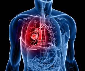 top lung cancer oncologist delhi