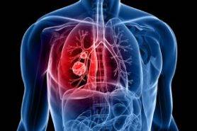 top lung cancer oncologist delhi